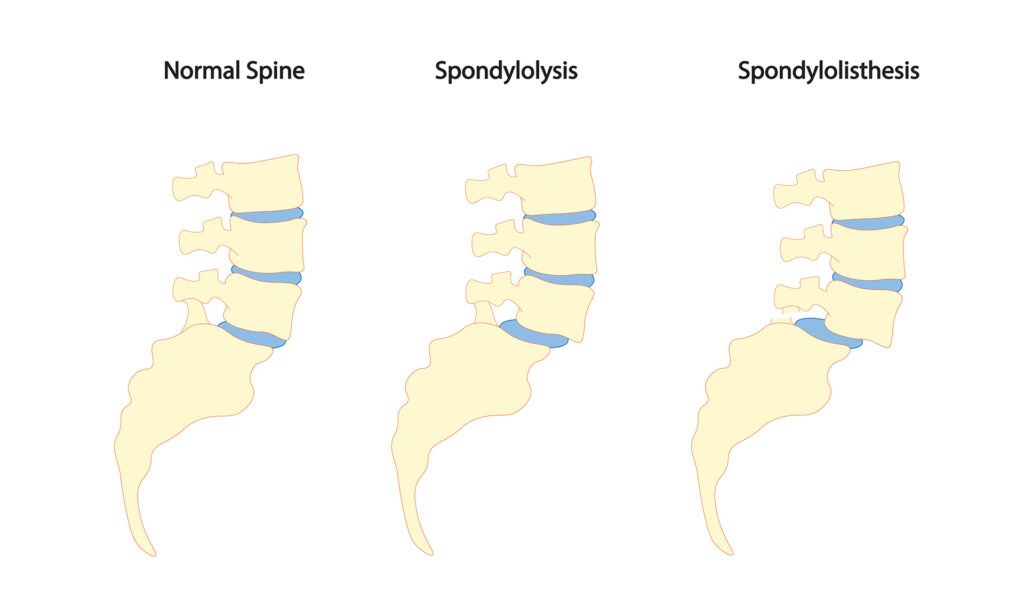 Spondylolysis and Spondylolisthesis illustration. Spine and sacr